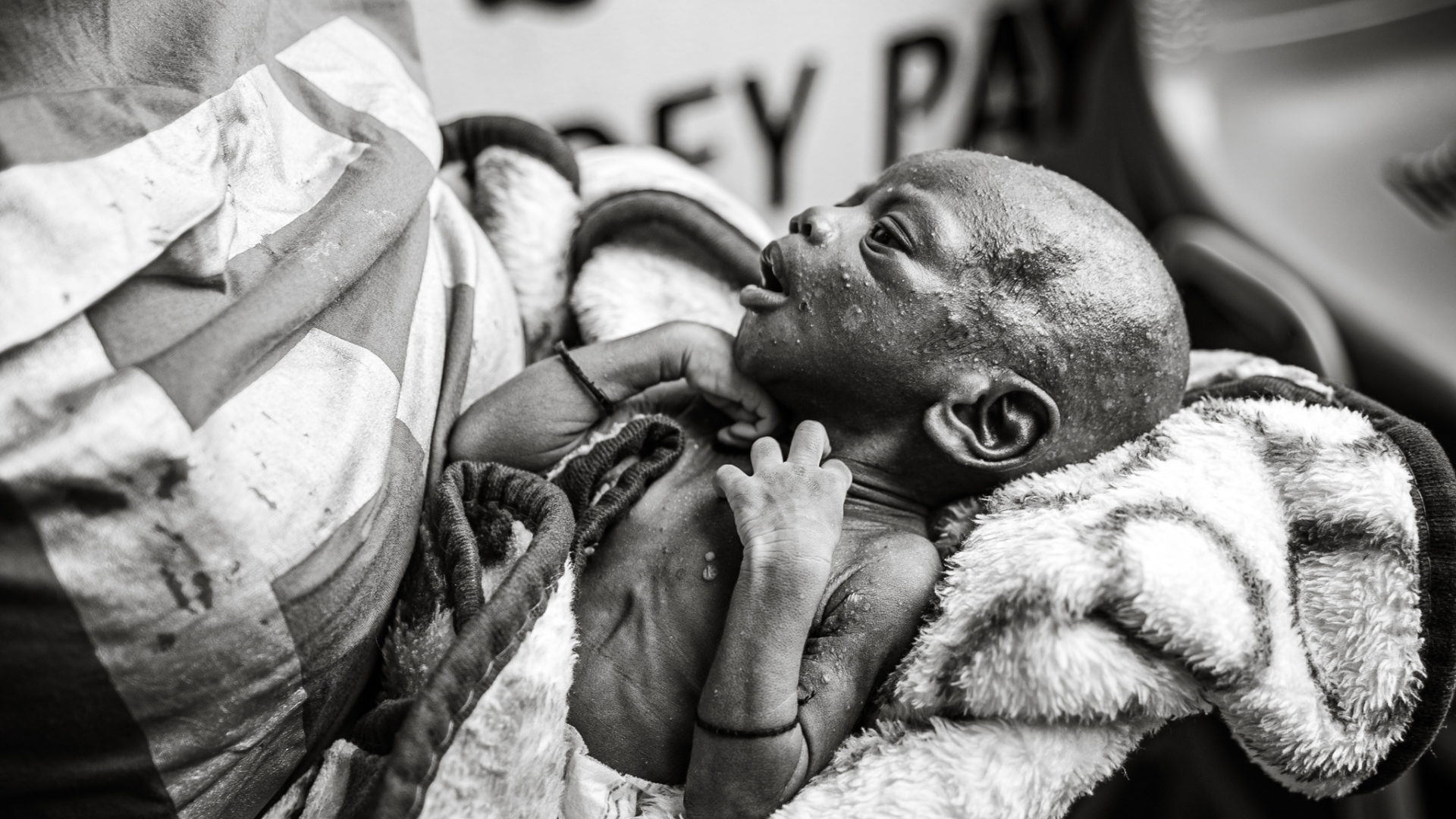 A severely malnourished infant, held wrapped in a blanket